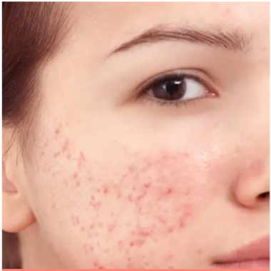 Soins peau grasse, mixte et acné